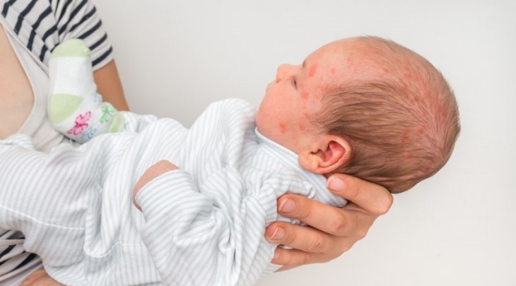 Gamot sa rashes ng baby | RiteMED