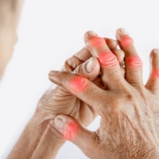7 Bad Habits na Dapat Iwasan Para Hindi Magka-arthritis